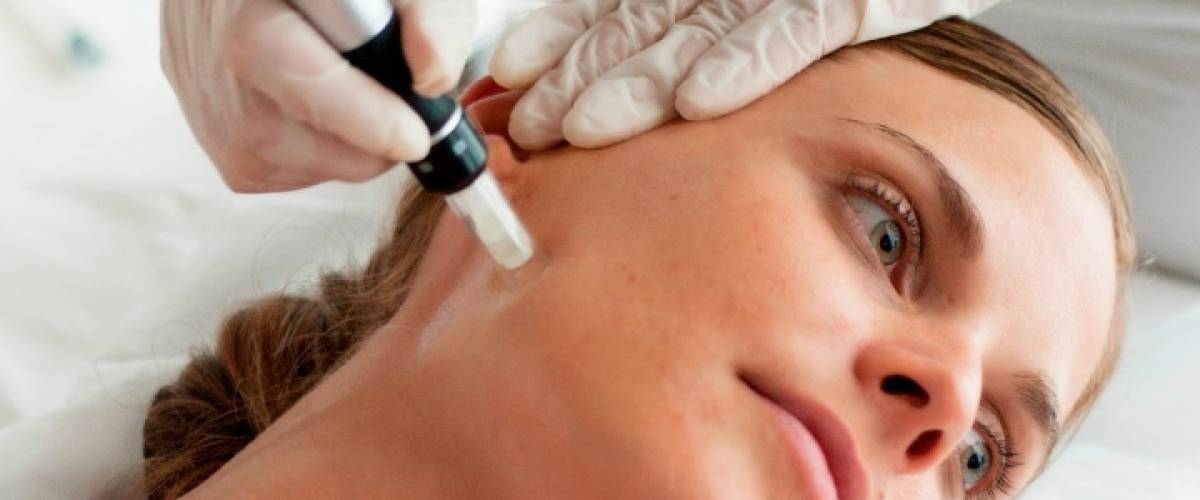 beetje ondergoed Welsprekend Microneedling | Ceulen Klinieken